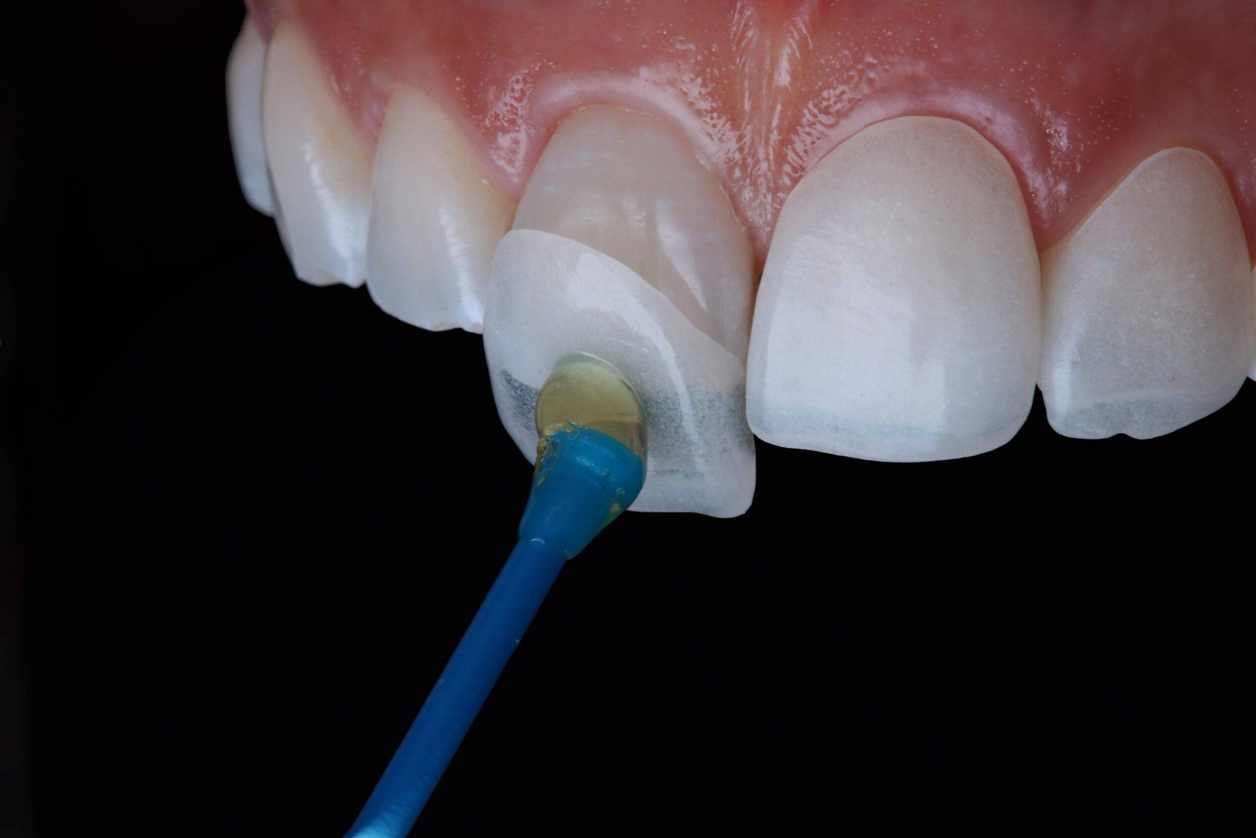 Improve Your Smile with Dental Veneers at Inima Dental Marbella