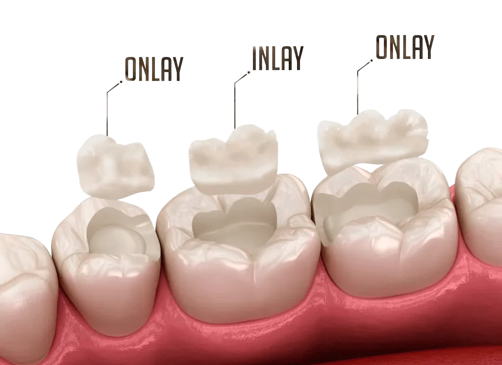 Onlays/Inlays vs. Conventional Fillings