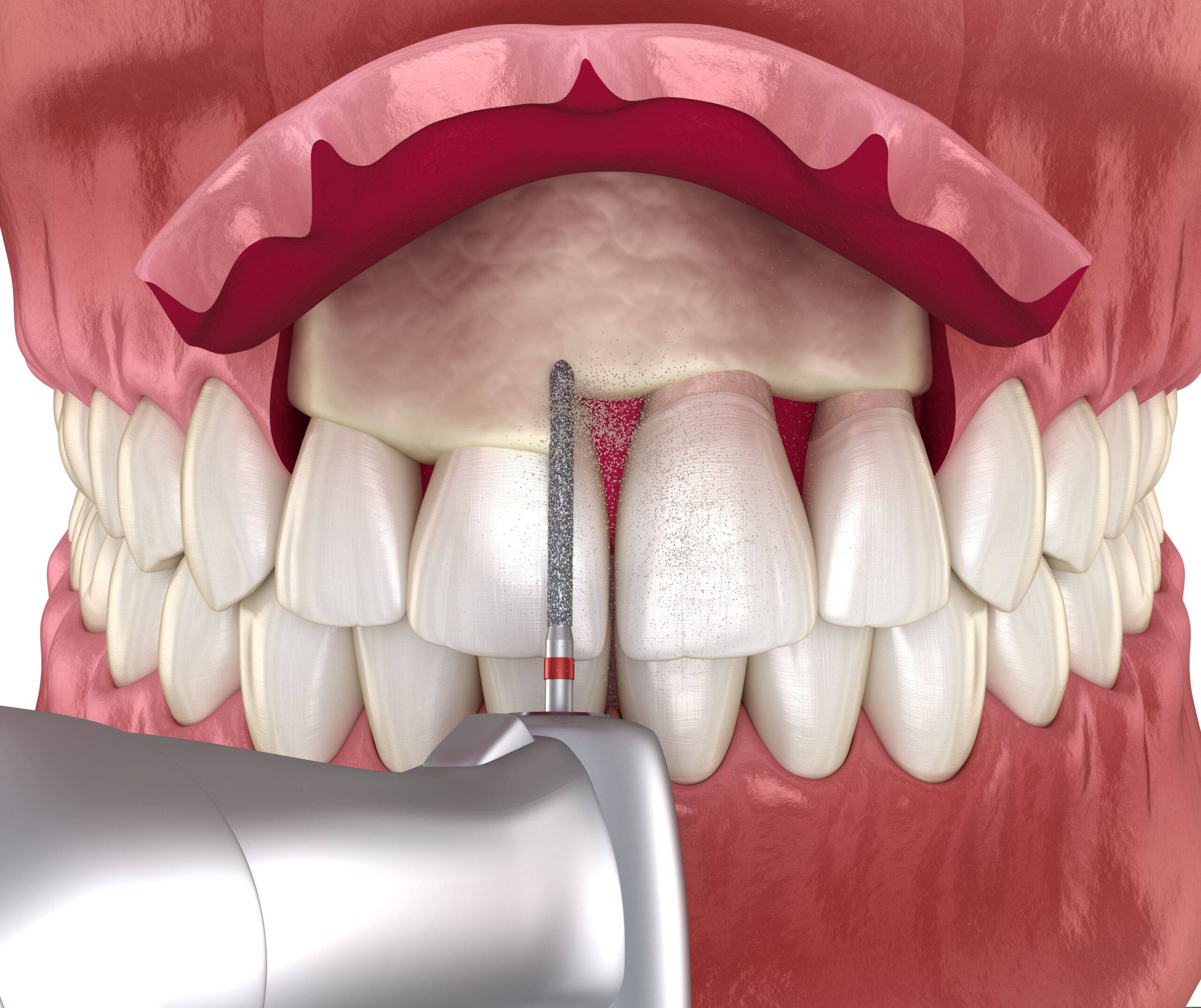 Periodontal Plastic Surgery at Inima Dental Marbella