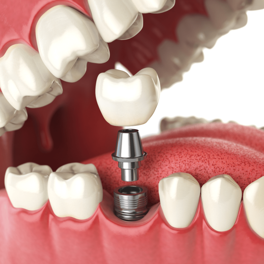 Straumann dental implants Marbella