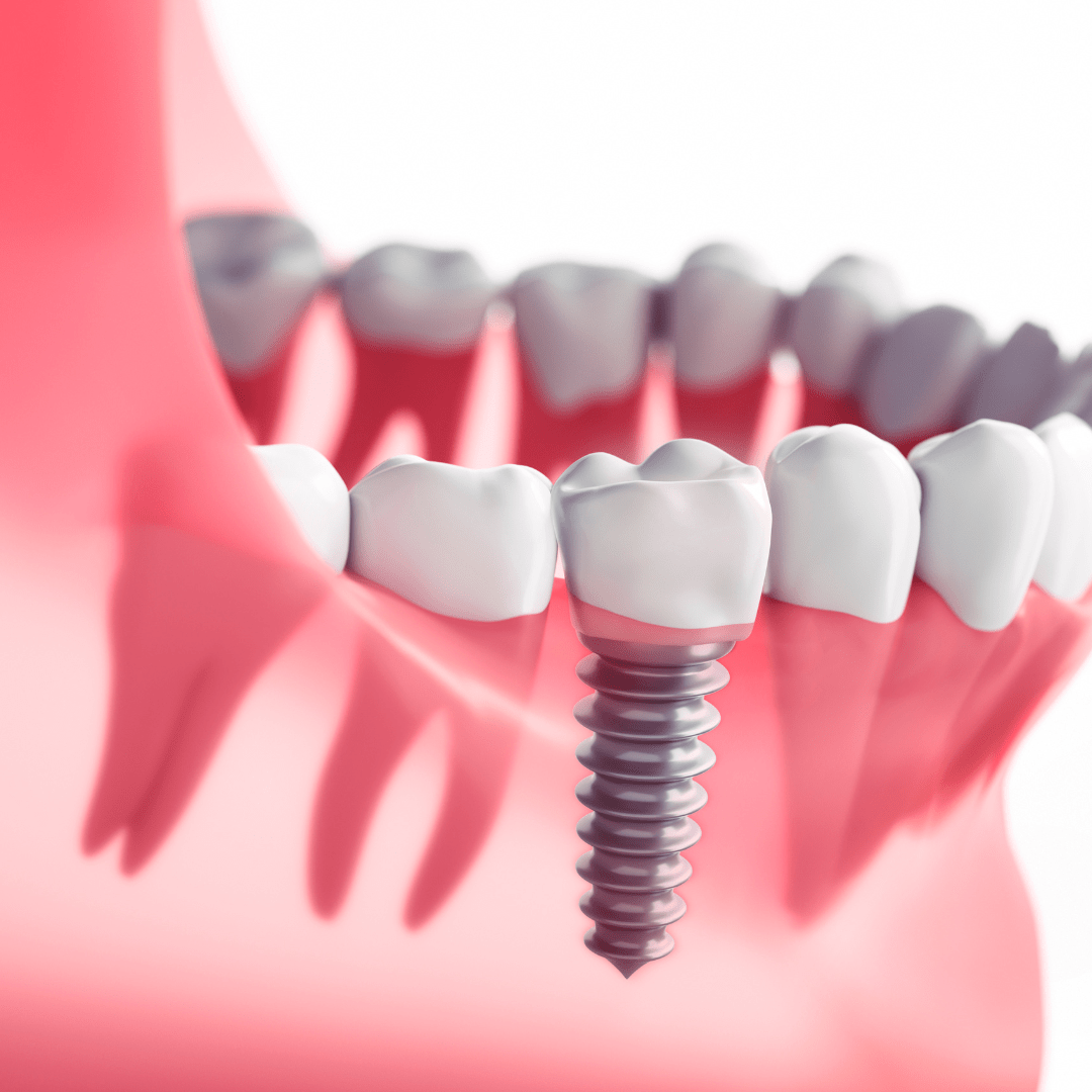 placement straumann implants