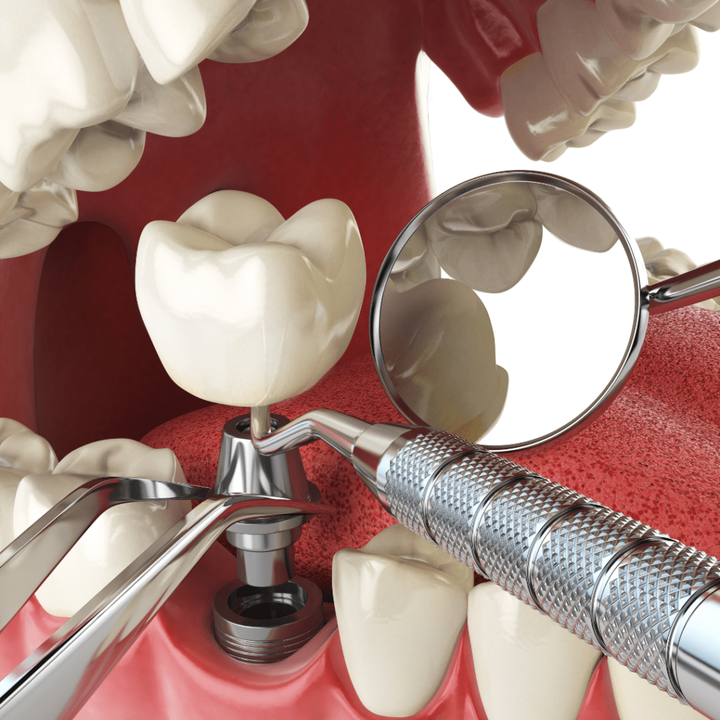 colocación implantes Straumann