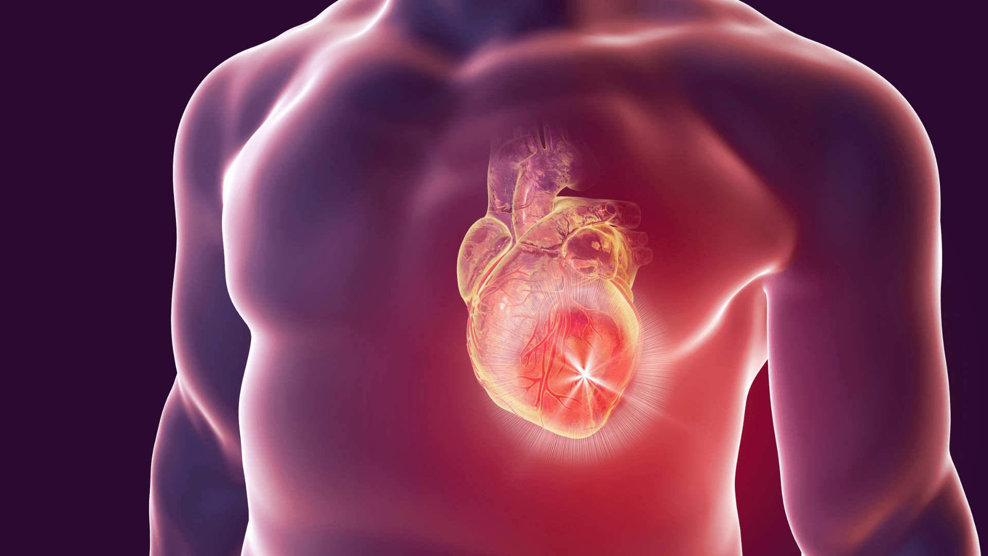 periodontitis myocardial infarctions