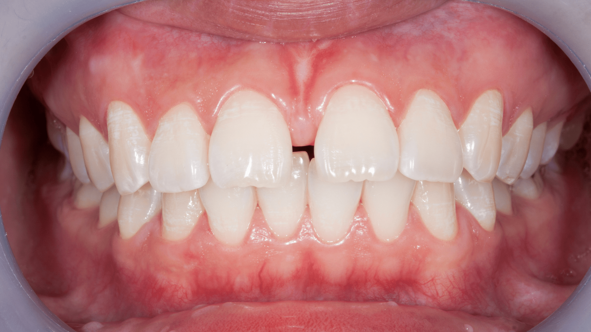 diastema dental