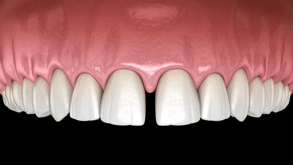 dental diastema